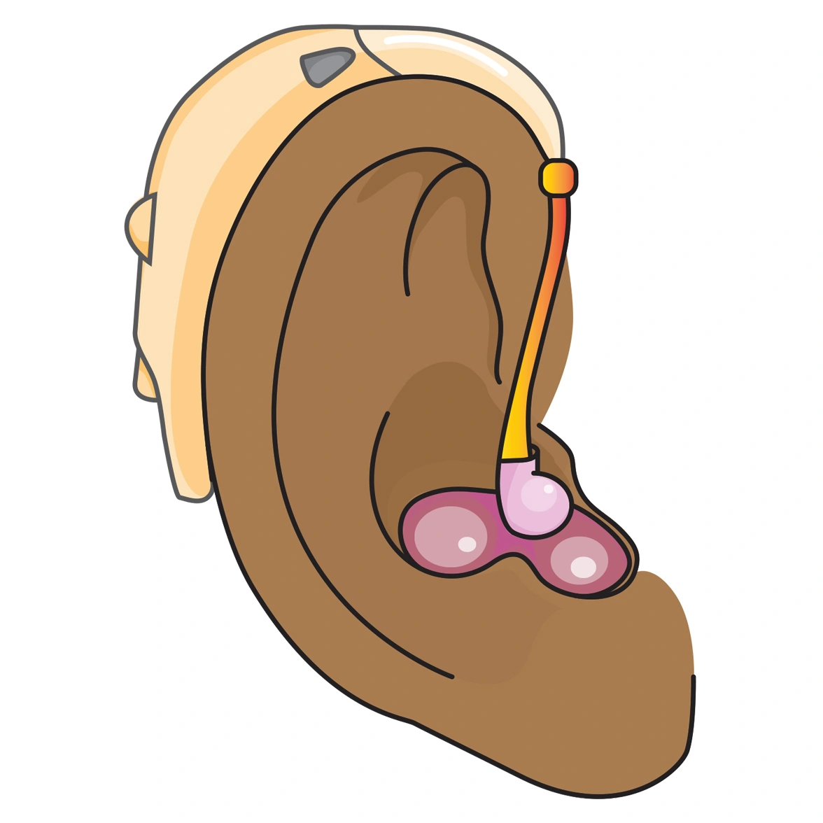 *Hearing aids – a small electronic device that fits onto the ear and can help someone to hear better.