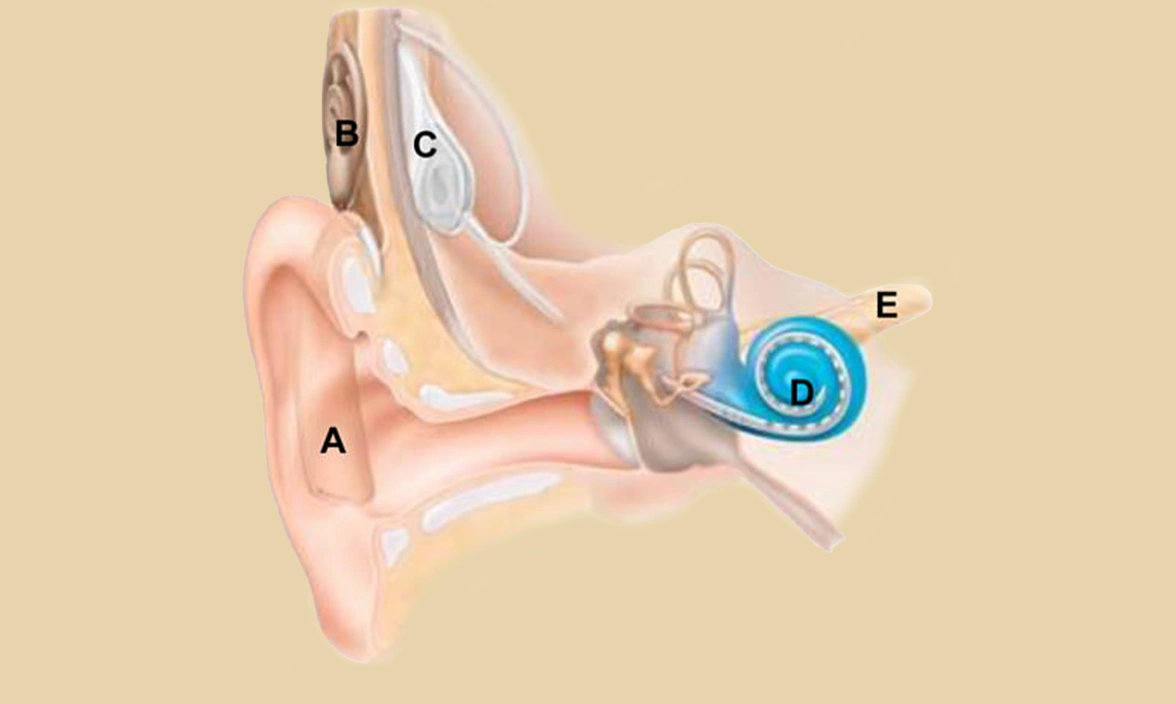 Illustration of the inside of an ear fitted with a cochlear implant