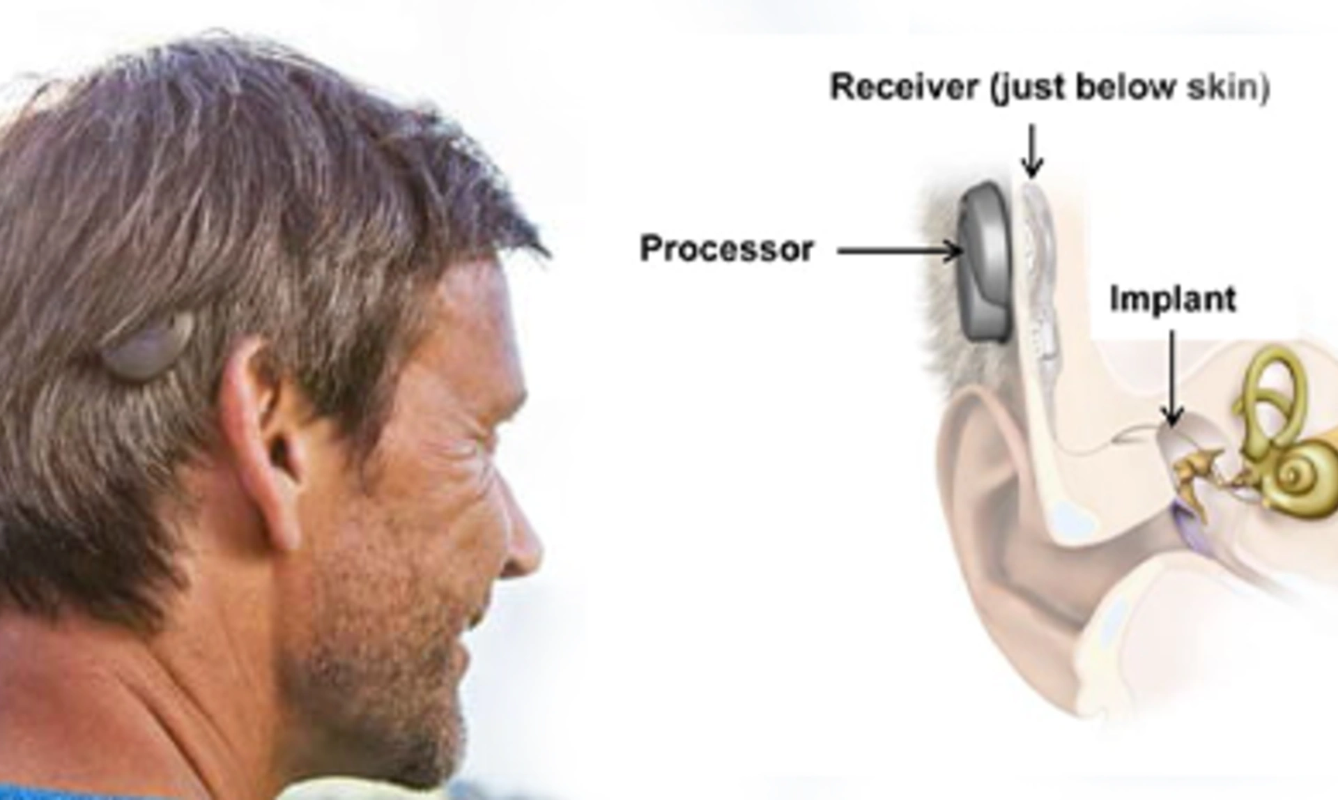 Man with circular implant visible through hair just behind ear inset with a diagram of the implant inside the ear and skull