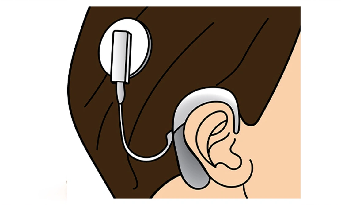 Illustration of cochlear implant
